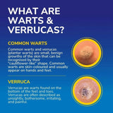 Scholl Freeze Away Max Verruca & Wart Remover - O'Sullivans Pharmacy